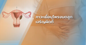 เยื่อบุโพรงมดลูกเจริญผิดที่