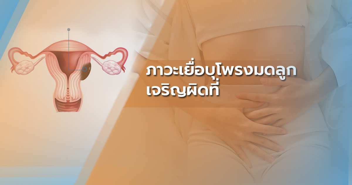 เยื่อบุโพรงมดลูกเจริญผิดที่