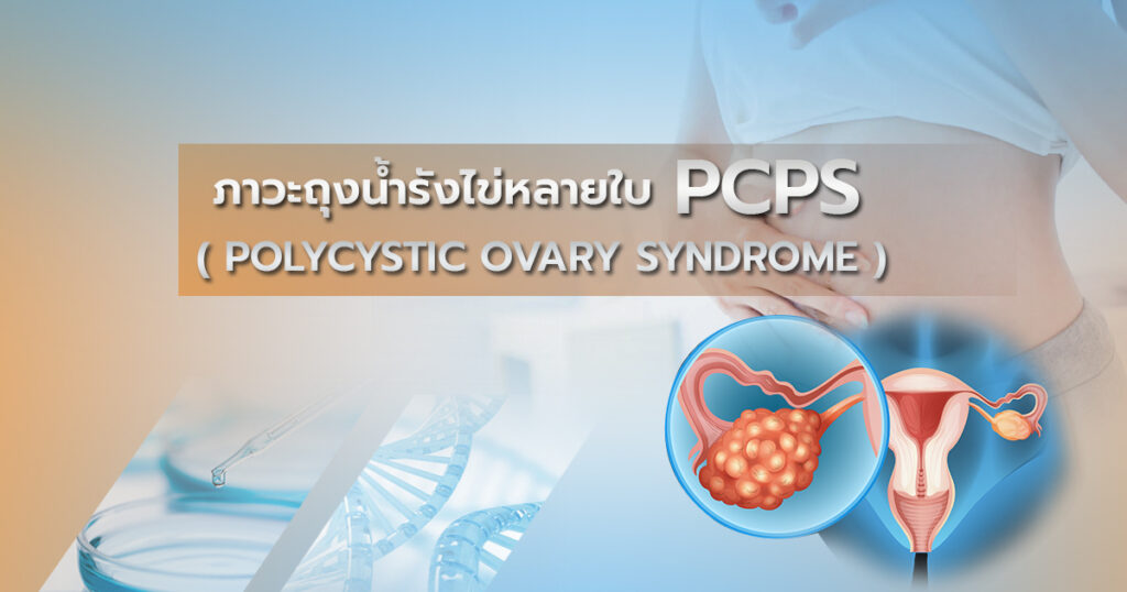 ภาวะ PCOS